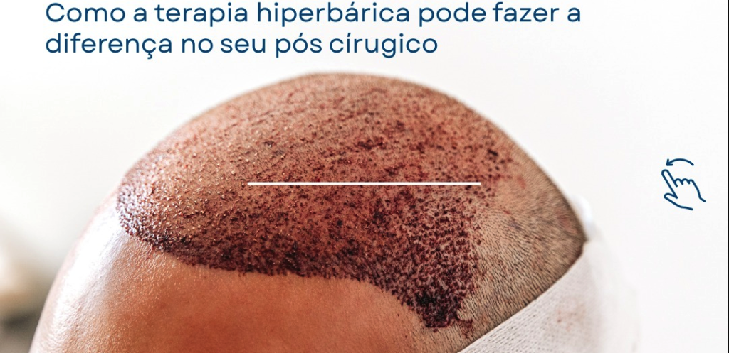 hiperbarica transplante capilar recuperação pós cirurgico criciuuma